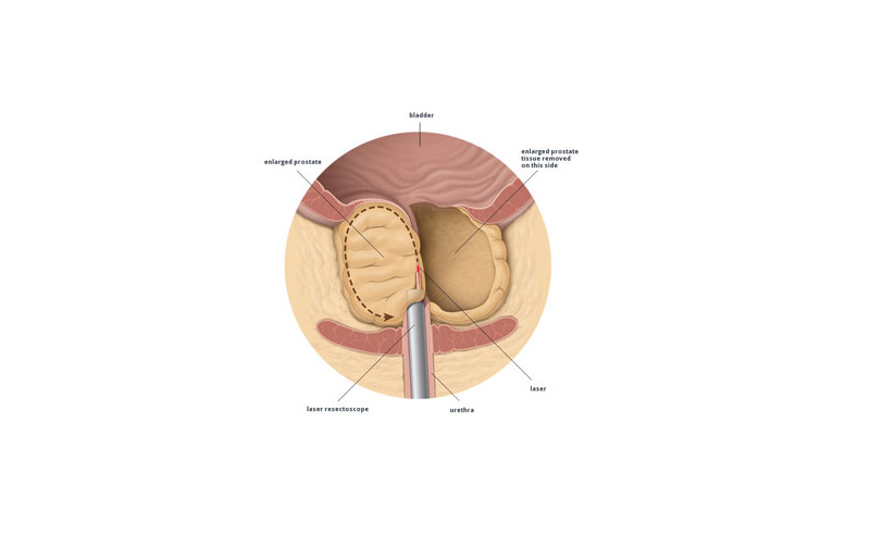 Laser Prostatectomy – Prostate Laser Surgery